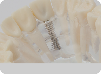インプラント